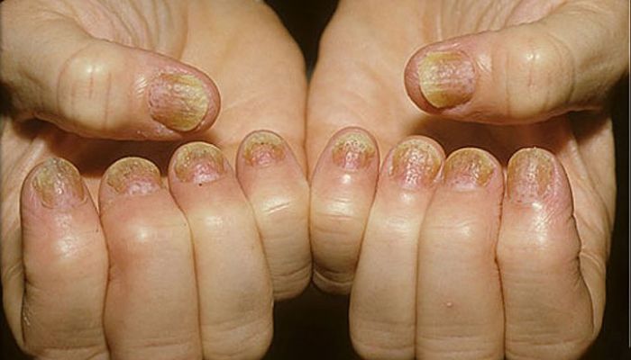 hongos en las uñas de las manos