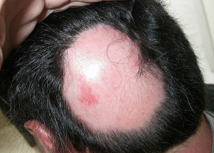 Tratamiento Para La Alopecia Areata