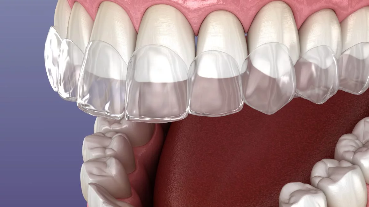 alineadores dentales